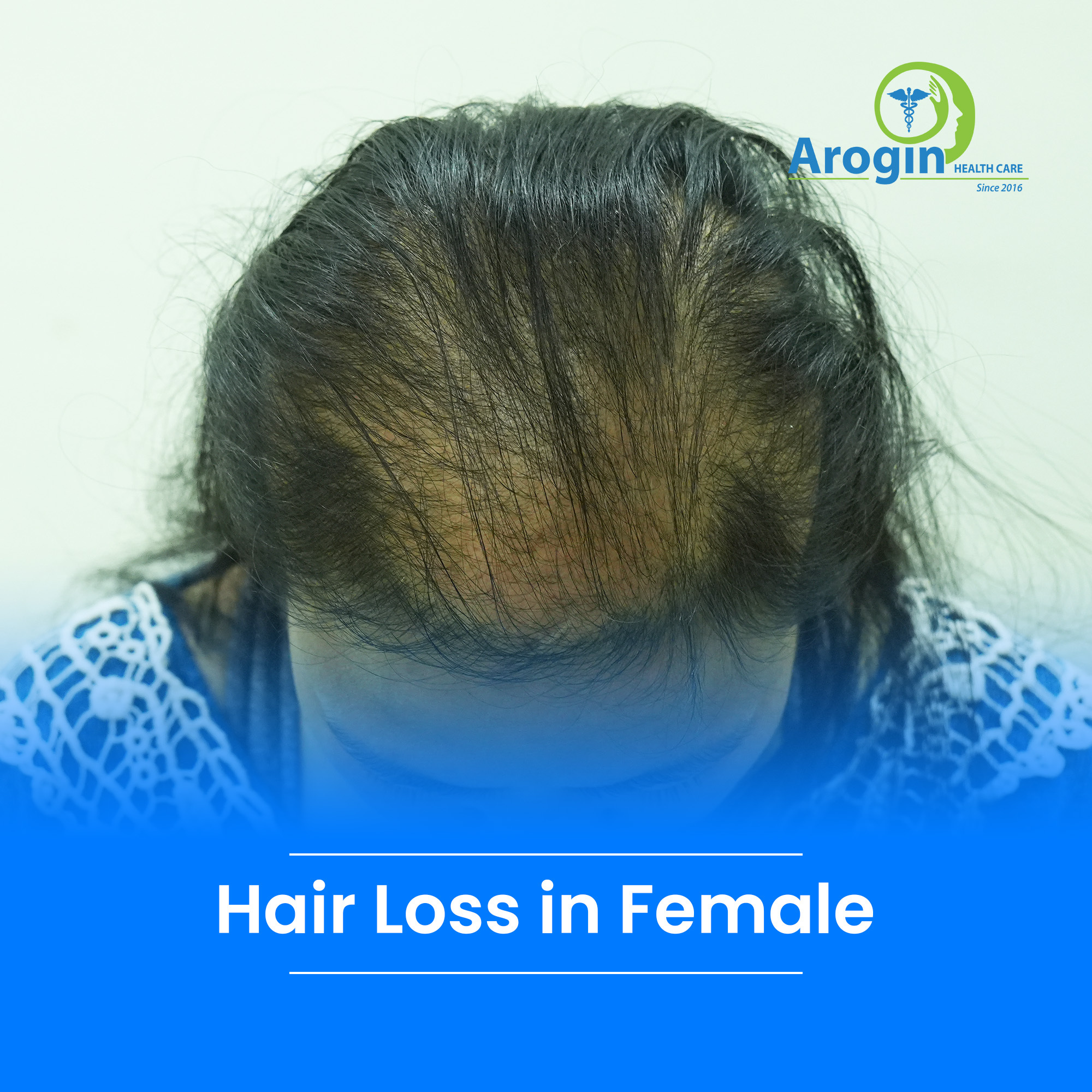 Hair Loss in Female